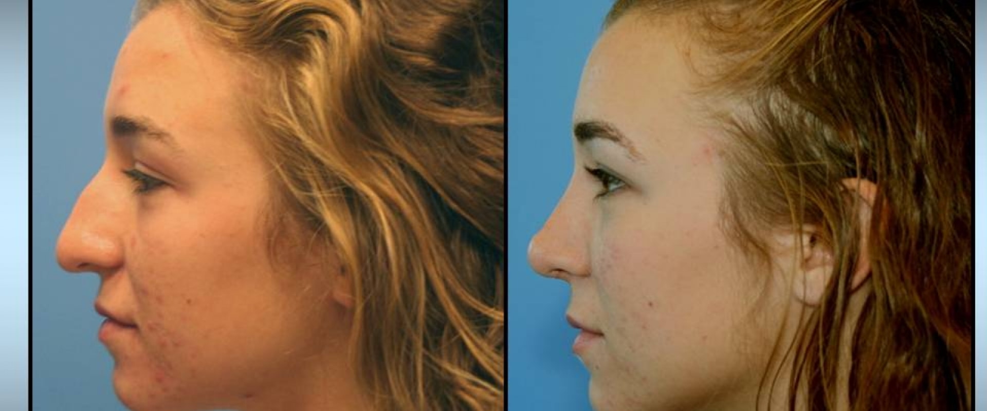 Top Rhinoplasty Surgeon in Beverly Hills CA