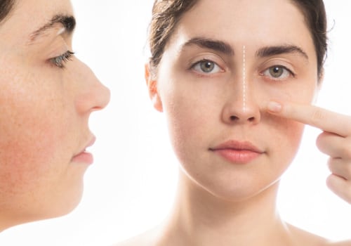 The Benefits of Rhinoplasty Surgeon In Beverly Hills CA