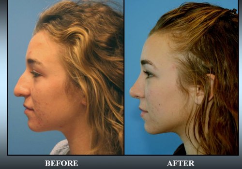 Top Rhinoplasty Surgeon in Beverly Hills CA